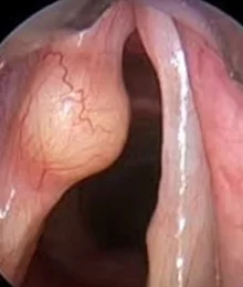 Szájüreg, garat vagy gége beningus tumor eltávolítása