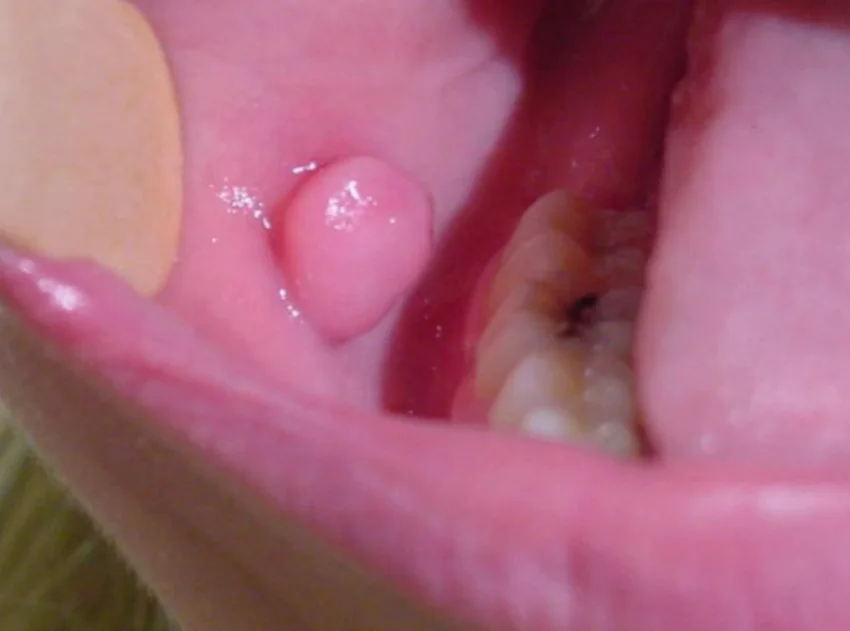 Szájüreg, garat vagy gége beningus tumor eltávolítása