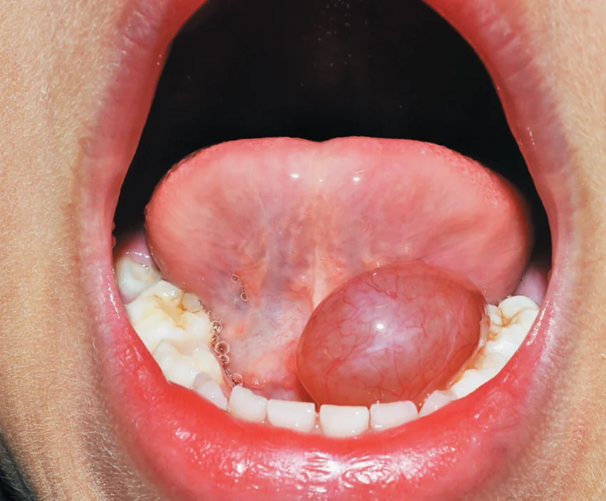 Szájüreg, garat vagy gége beningus tumor eltávolítása