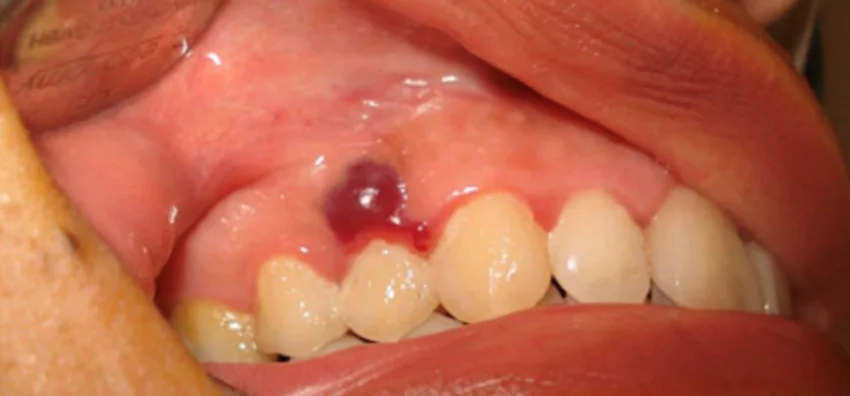 Szájüreg, garat vagy gége beningus tumor eltávolítása