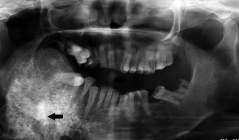 Szájüreg, garat vagy gége beningus tumor eltávolítása