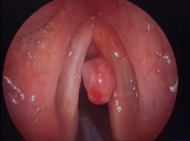 Szájüreg, garat vagy gége beningus tumor eltávolítása