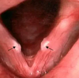 Szájüreg, garat vagy gége beningus tumor eltávolítása