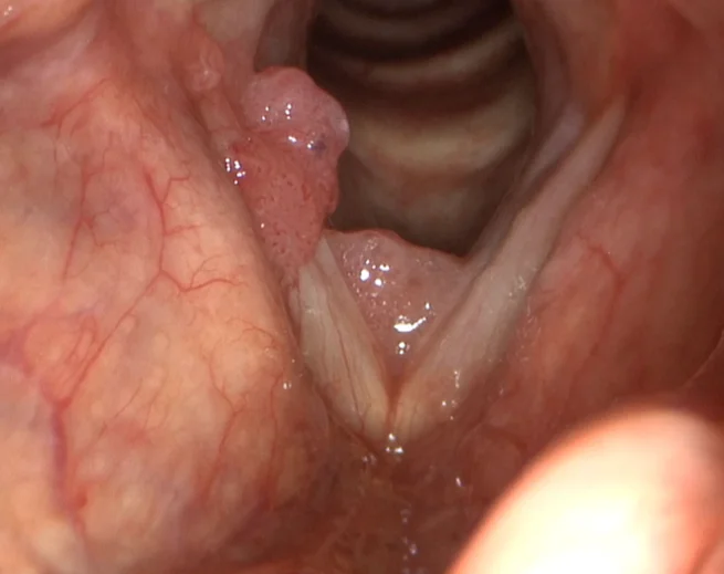 Szájüreg, garat vagy gége beningus tumor eltávolítása