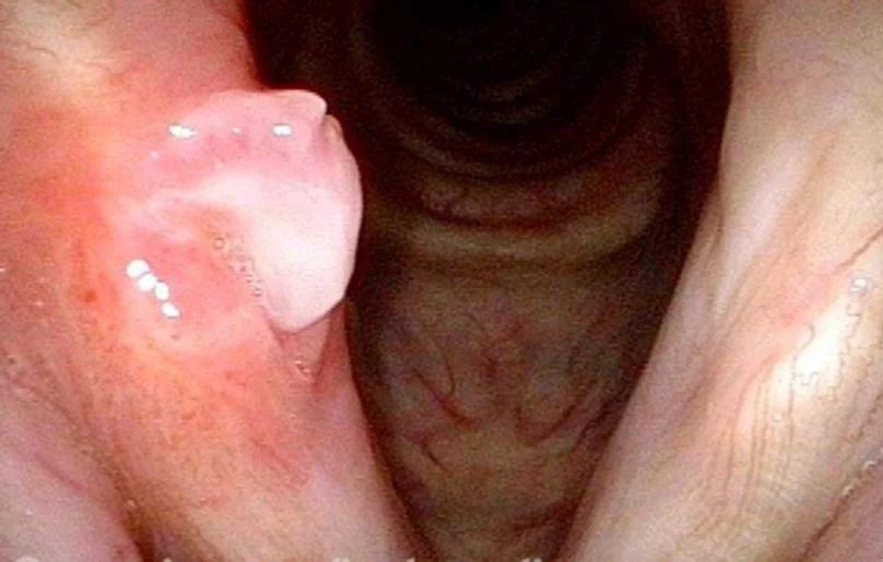 Szájüreg, garat vagy gége beningus tumor eltávolítása