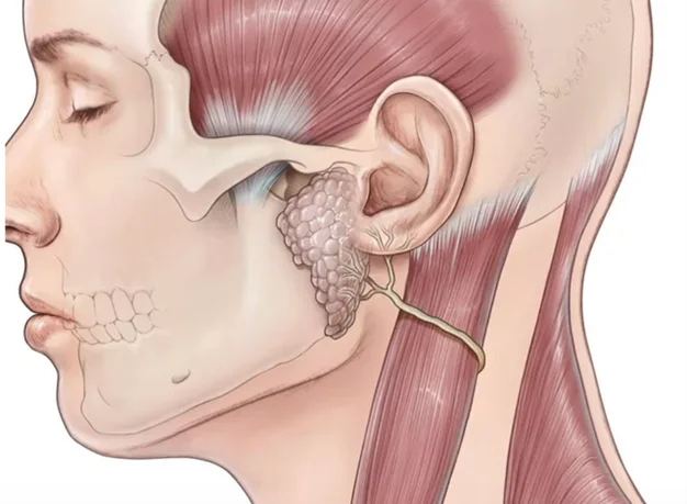 Fültőmirigy tumor eltávolítása