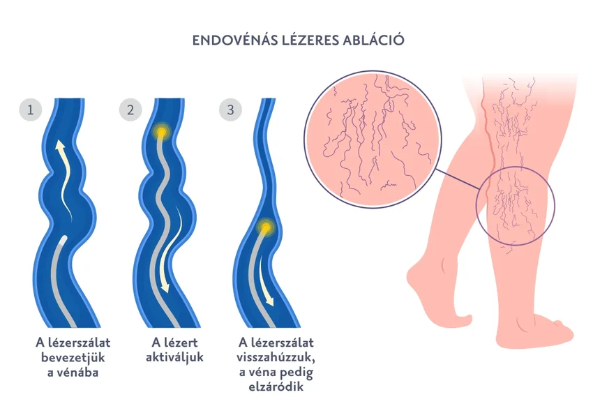 Endovénás visszérkezelés