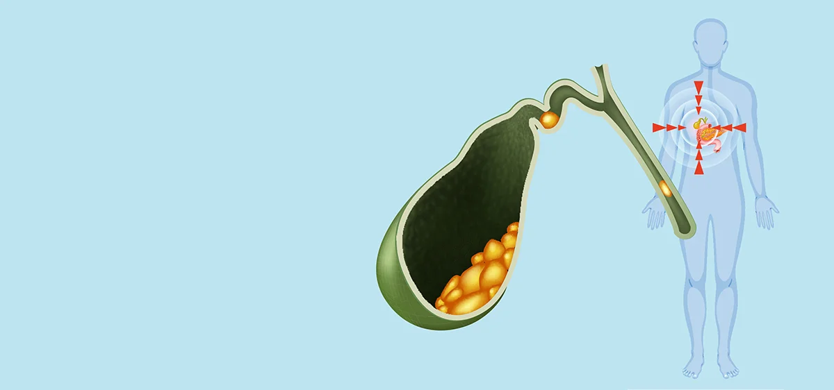 Epekő: tünetek, kockázatok és kezelési lehetőségek