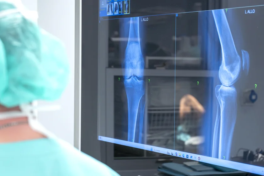 Új robotasszisztált térdműtét hozhat áttörést a részleges porckopással élők kezelésében